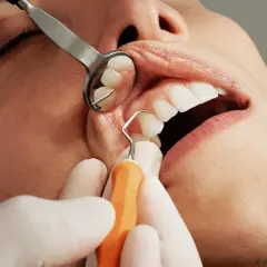 Dentysta wykonuje skaling, usuwając kamień nazębny. Widoczne narzędzia i zęby.