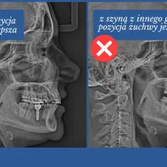 Dwa zdjęcia rentgenowskie szczęki. Po lewej pozycja żuchwy lepsza bez szyny. Po prawej z szyną z innego gabinetu pozycja żuchwy gorsza, co może prowadzić do zagryzania zębów.