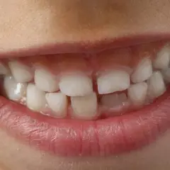 Uśmiech dziąsłowy u dziecka, z widocznymi ząbkami i różowymi dziąsłami.