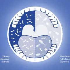 Porównanie zdrowego i niezrównoważonego mikrobiomu jamy ustnej. Zmiany te mogą być związane z eludril skutki uboczne.