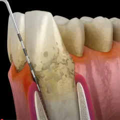 Narzędzie dentystyczne usuwa osad, gdzie rozwijają się bakterie w jamie ustnej. Widoczne są zęby, dziąsła i kamień nazębny.