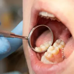Dentysta bada zęby, widoczna próchnica przy dziąśle.