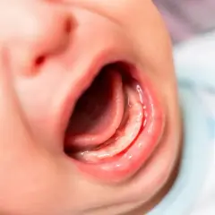 Zbliżenie na usta niemowlaka. Widoczne dziąsła i język, mogące sugerować za krótkie wędzidełko u niemowlaka objawy.