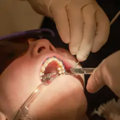 Ortodonta pracuje nad aparatem, który obejmuje łuki podniebienne. Dziecko ma na sobie okulary ochronne.