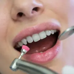 Zabieg polerowania zębów u dentysty. Czy lakierowanie zębów jest szkodliwe? Nie, to bezpieczna metoda higienizacji.