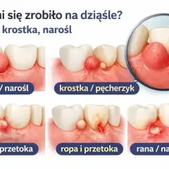 Guzek, krostka, ropień na dziąśle. Czy lekarstwo w zębie boli? Ilustracje pokazują różne zmiany przyzębia.