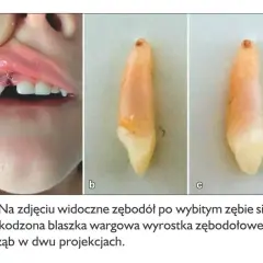 Zębodół po wybiciu pierwszego zęba u dziecka, widoczna rana i uszkodzona warga. Obok wybity ząb w dwóch ujęciach.
