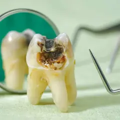 Zepsuty ząb z widoczną próchnicą, która może powodować nieprzyjemny zapach. Obok lustro dentystyczne i narzędzia.