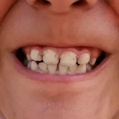 Zęby dziecka z widocznym kamieniem. Dowiedz się, jak pozbyć się kamienia na zębach u dziecka i zadbać o jego higienę.