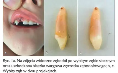 Zębodół po wybiciu pierwszego zęba u dziecka, widoczna rana i uszkodzona warga. Obok wybity ząb w dwóch ujęciach.