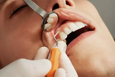 Dentysta wykonuje skaling, usuwając kamień nazębny. Widoczne narzędzia i zęby.