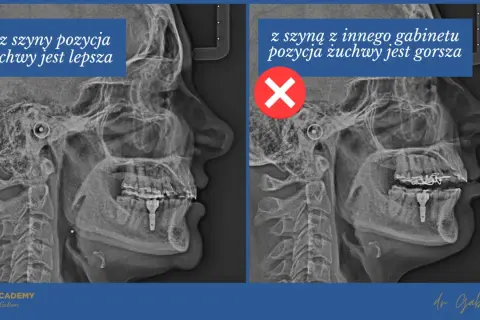 Dwa zdjęcia rentgenowskie szczęki. Po lewej pozycja żuchwy lepsza bez szyny. Po prawej z szyną z innego gabinetu pozycja żuchwy gorsza, co może prowadzić do zagryzania zębów.