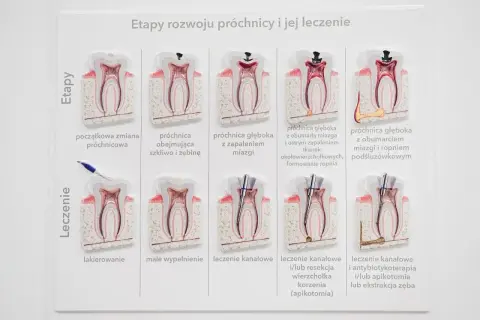 Model zęba pokazuje rozwój próchnicy i jej leczenie. Widać etapy od początkowej zmiany do ropnia, a następnie metody leczenia, w tym kanałowe, które pomaga wyciągnąć ropę z zęba.