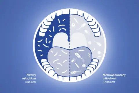 Porównanie zdrowego i niezrównoważonego mikrobiomu jamy ustnej. Zmiany te mogą być związane z eludril skutki uboczne.