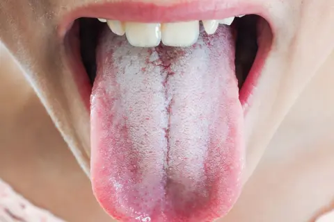 Język pokryty białym nalotem, odczuwana suchość w ustach.