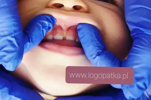 Dziecko z widocznym podcięciem wędzidełka wargi górnej. Specjalista w niebieskich rękawiczkach delikatnie rozchyla usta malucha.