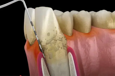 Narzędzie dentystyczne usuwa osad, gdzie rozwijają się bakterie w jamie ustnej. Widoczne są zęby, dziąsła i kamień nazębny.