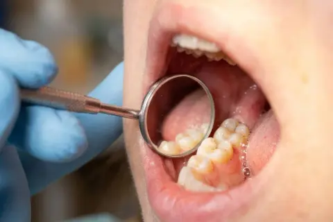 Dentysta bada zęby, widoczna próchnica przy dziąśle.