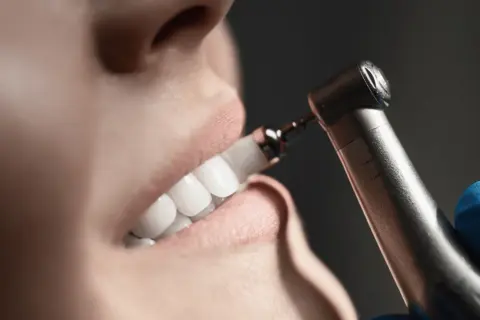 Zbliżenie na uśmiech pacjentki podczas zabiegu skaling zębów co to. Dentysta poleruje zęby.