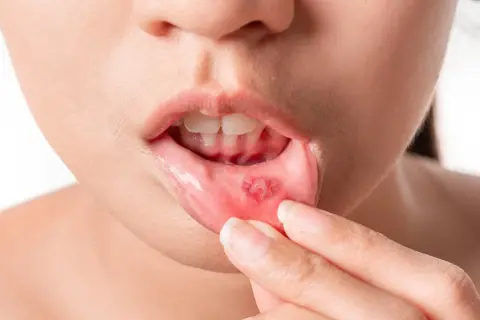 Afta od czego się robi? Widoczna rana na wewnętrznej stronie wargi, która może być przyczyną bólu.