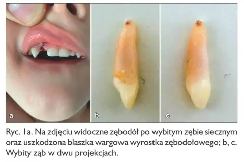 Zębodół po wybiciu pierwszego zęba u dziecka, widoczna rana i uszkodzona warga. Obok wybity ząb w dwóch ujęciach.