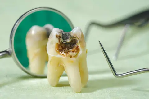 Zepsuty ząb z widoczną próchnicą, która może powodować nieprzyjemny zapach. Obok lustro dentystyczne i narzędzia.