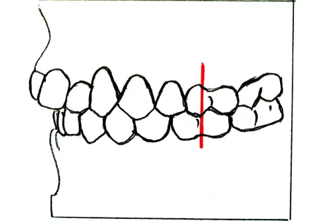 Ilustracja przedstawiająca zgryz z zaznaczoną czerwoną linią.