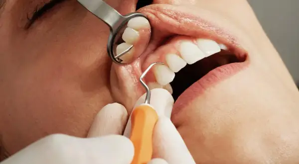 Dentysta wykonuje skaling, usuwając kamień nazębny. Widoczne narzędzia i zęby.