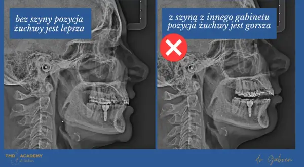 Dwa zdjęcia rentgenowskie szczęki. Po lewej pozycja żuchwy lepsza bez szyny. Po prawej z szyną z innego gabinetu pozycja żuchwy gorsza, co może prowadzić do zagryzania zębów.