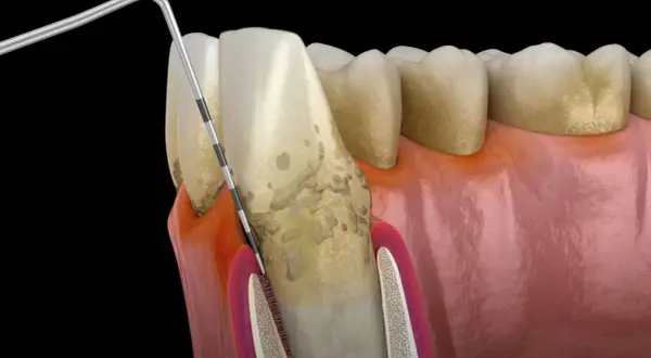 Narzędzie dentystyczne usuwa osad, gdzie rozwijają się bakterie w jamie ustnej. Widoczne są zęby, dziąsła i kamień nazębny.