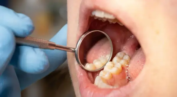 Dentysta bada zęby, widoczna próchnica przy dziąśle.