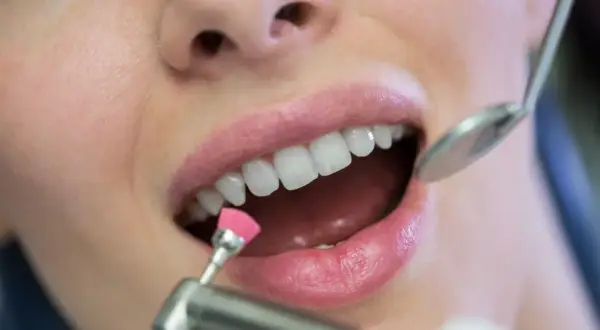 Zabieg polerowania zębów u dentysty. Czy lakierowanie zębów jest szkodliwe? Nie, to bezpieczna metoda higienizacji.