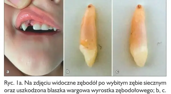 Zębodół po wybiciu pierwszego zęba u dziecka, widoczna rana i uszkodzona warga. Obok wybity ząb w dwóch ujęciach.