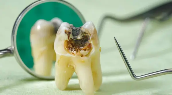 Zepsuty ząb z widoczną próchnicą, która może powodować nieprzyjemny zapach. Obok lustro dentystyczne i narzędzia.