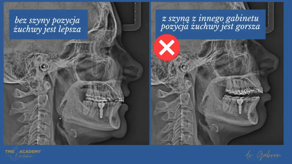 Dwa zdjęcia rentgenowskie szczęki. Po lewej pozycja żuchwy lepsza bez szyny. Po prawej z szyną z innego gabinetu pozycja żuchwy gorsza, co może prowadzić do zagryzania zębów.