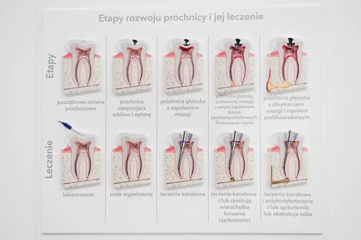 Model zęba pokazuje rozwój próchnicy i jej leczenie. Widać etapy od początkowej zmiany do ropnia, a następnie metody leczenia, w tym kanałowe, które pomaga wyciągnąć ropę z zęba.