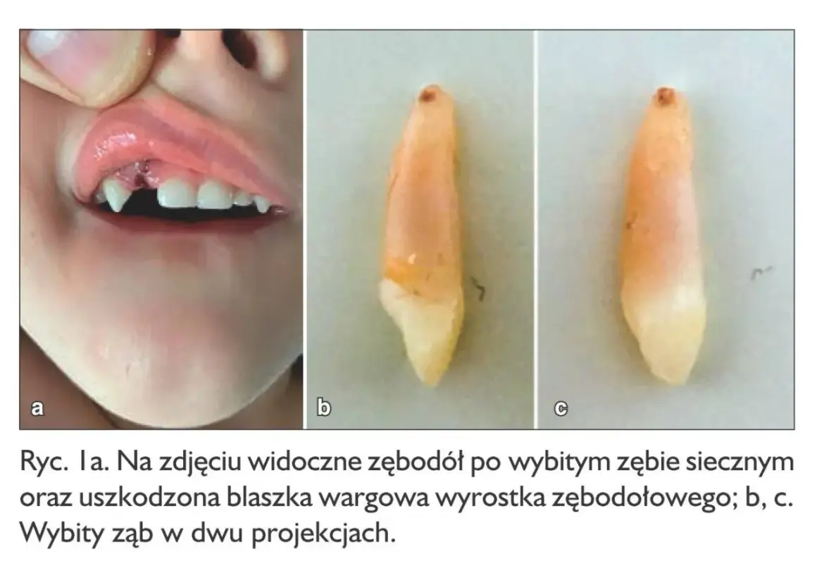 Zębodół po wybiciu pierwszego zęba u dziecka, widoczna rana i uszkodzona warga. Obok wybity ząb w dwóch ujęciach.