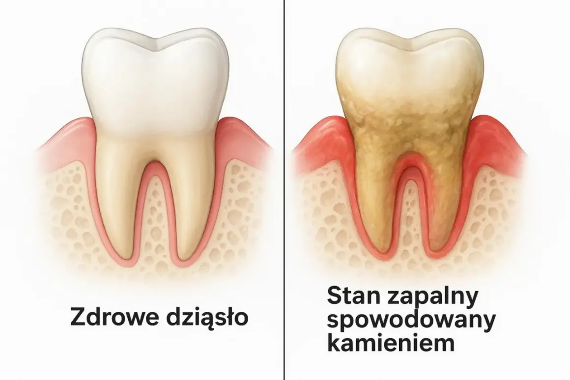 Porównanie zdrowego zęba z zębem z kamieniem nazębnym, który powoduje stan zapalny dziąseł. Czy kamień nazębny śmierdzi? Tak, może powodować nieprzyjemny zapach.