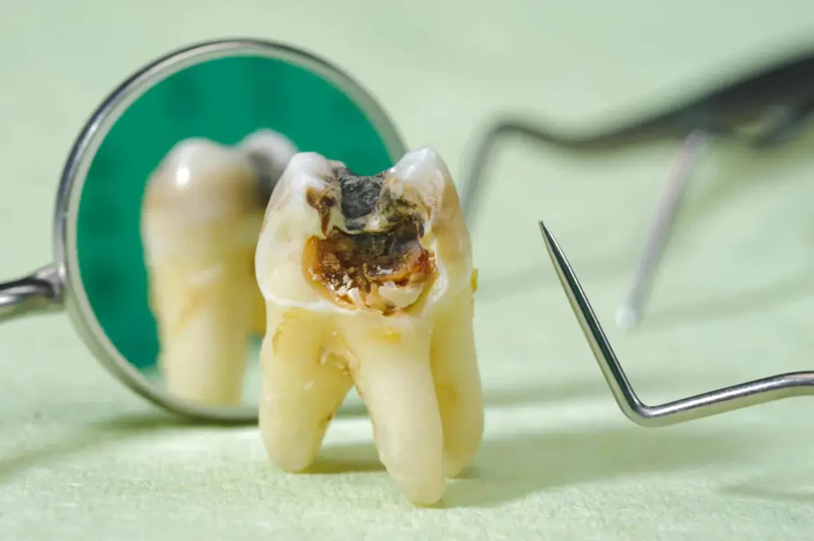Zepsuty ząb z widoczną próchnicą, która może powodować nieprzyjemny zapach. Obok lustro dentystyczne i narzędzia.