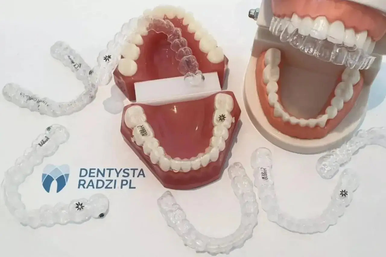 Przezroczysty aparat nakładkowy na modelach szczęk. Widoczne r&oacute;żne etapy leczenia ortodontycznego.