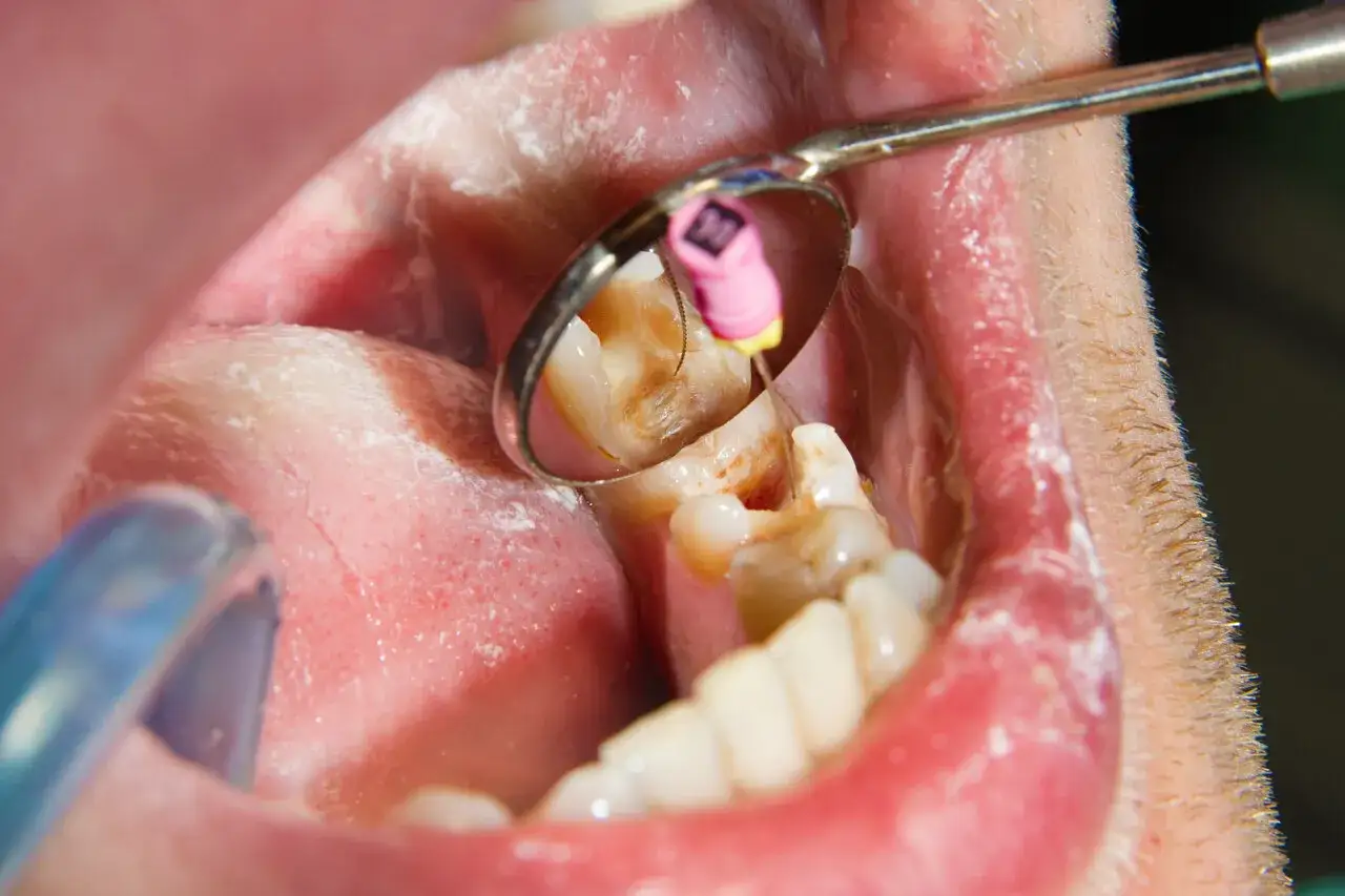 Dentysta używa narzędzia, by oczyścić kanał zęba, co wyciąga ropę z zęba.
