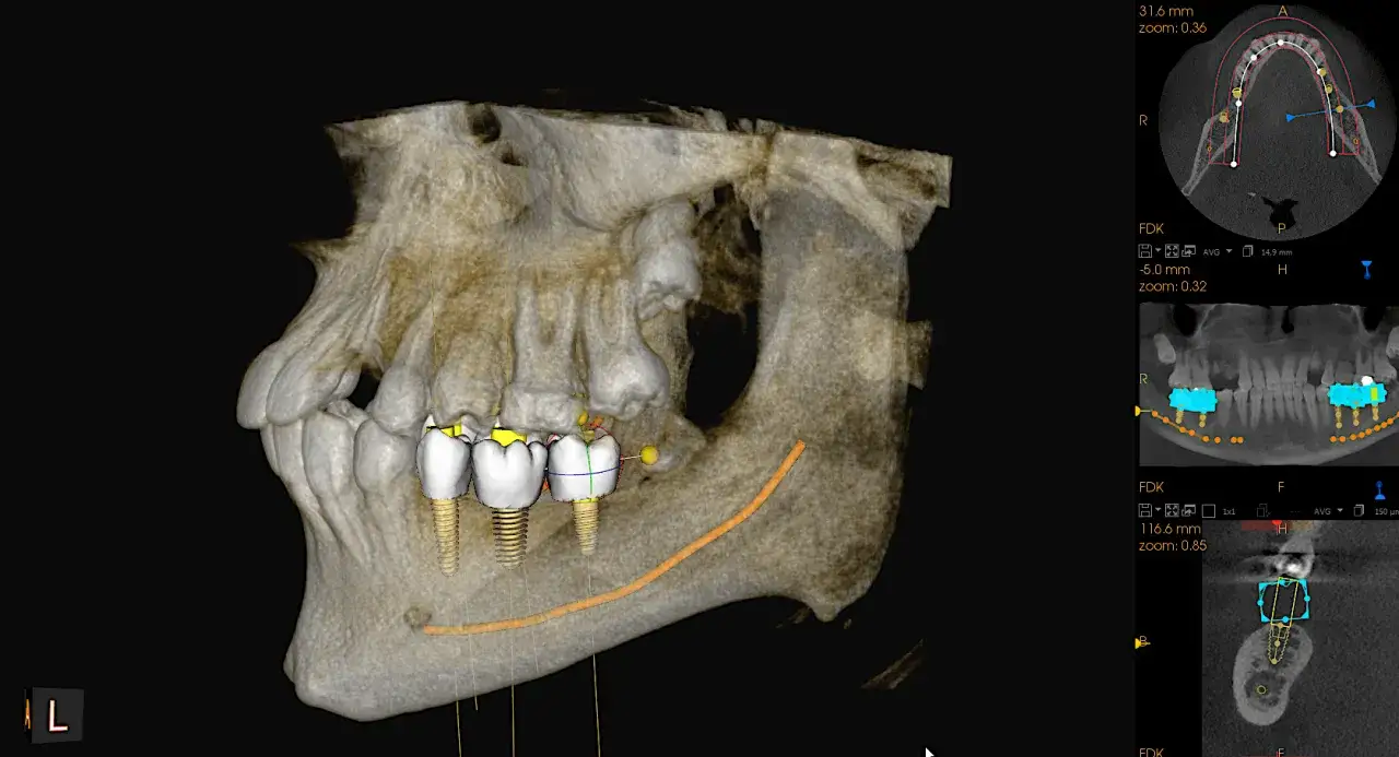 Model szczęki z implantami. Widoczne są potencjalne implanty przeciwwskazania, zaznaczone na ż&oacute;łto i niebiesko.
