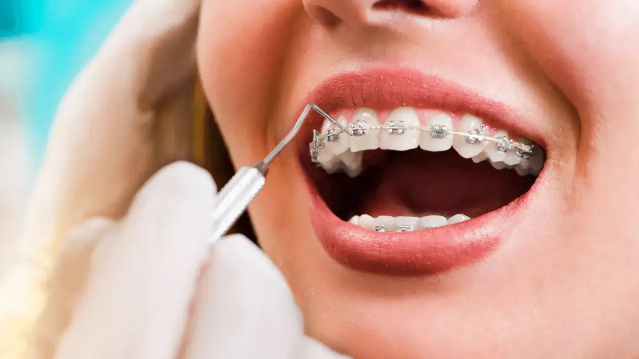 Zbliżenie na usta z aparatem ortodontycznym. Dentyści często pytają, ile nosi się aparat na zęby, a zdjęcie pokazuje jego działanie.