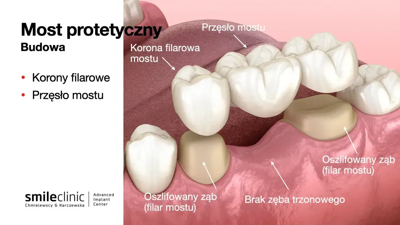 Most protetyczny z przęsłem i koronami filarowymi, pokazujący brak 4 i 5 zęba.