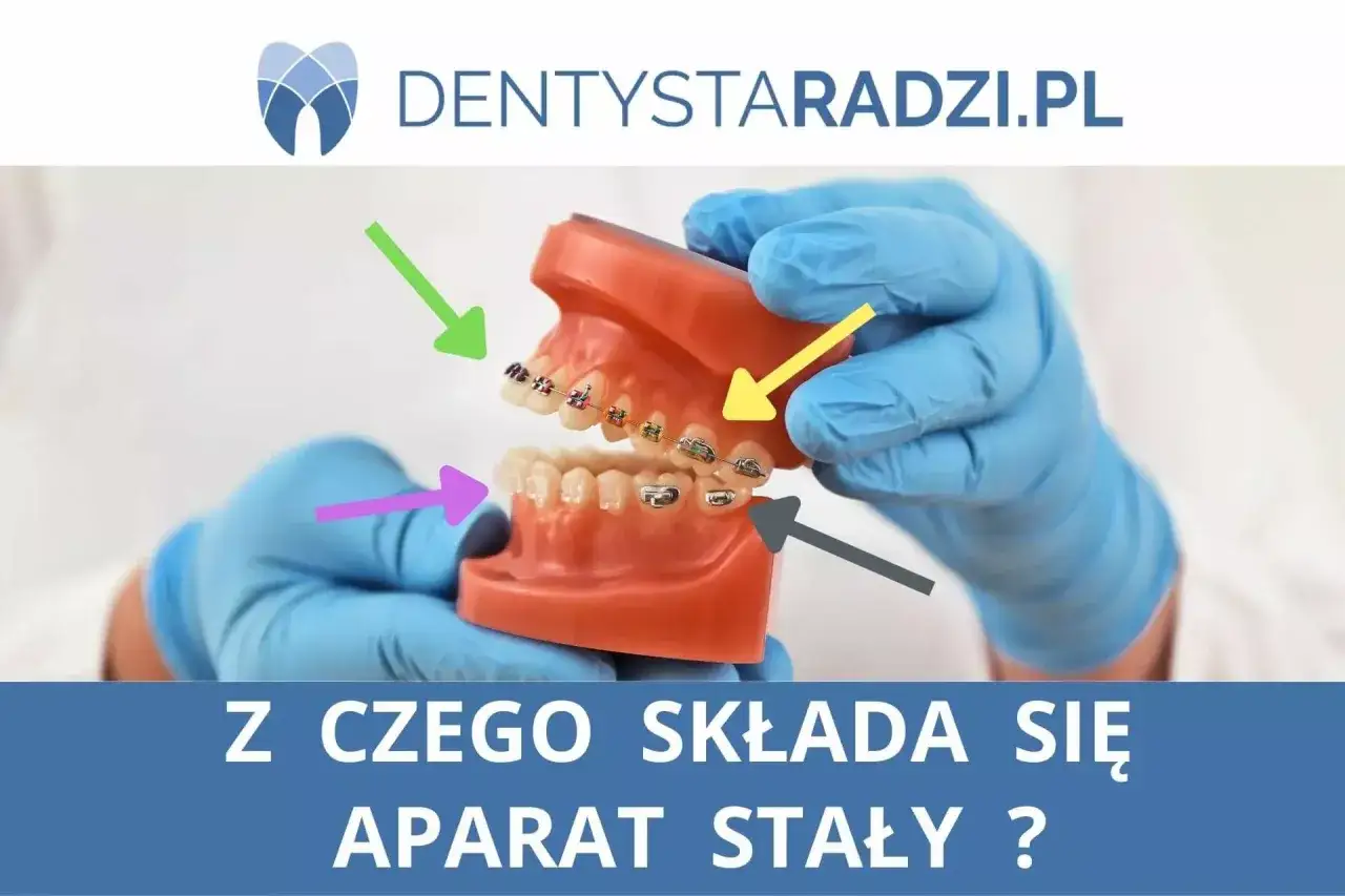Model szczęki z aparatem ortodontycznym, gdzie kolorowe strzałki wskazują elementy, w tym łuk metalowy.