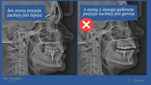 Dwa zdjęcia rentgenowskie szczęki. Po lewej pozycja żuchwy lepsza bez szyny. Po prawej z szyną z innego gabinetu pozycja żuchwy gorsza, co może prowadzić do zagryzania zębów.