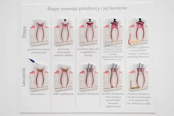 Model zęba pokazuje rozwój próchnicy i jej leczenie. Widać etapy od początkowej zmiany do ropnia, a następnie metody leczenia, w tym kanałowe, które pomaga wyciągnąć ropę z zęba.