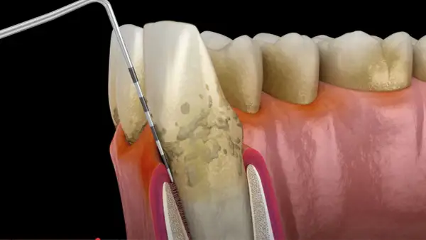 Narzędzie dentystyczne usuwa osad, gdzie rozwijają się bakterie w jamie ustnej. Widoczne są zęby, dziąsła i kamień nazębny.