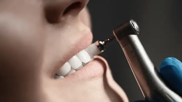 Zbliżenie na uśmiech pacjentki podczas zabiegu skaling zębów co to. Dentysta poleruje zęby.