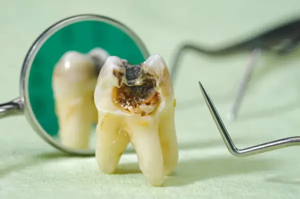 Zepsuty ząb z widoczną próchnicą, która może powodować nieprzyjemny zapach. Obok lustro dentystyczne i narzędzia.